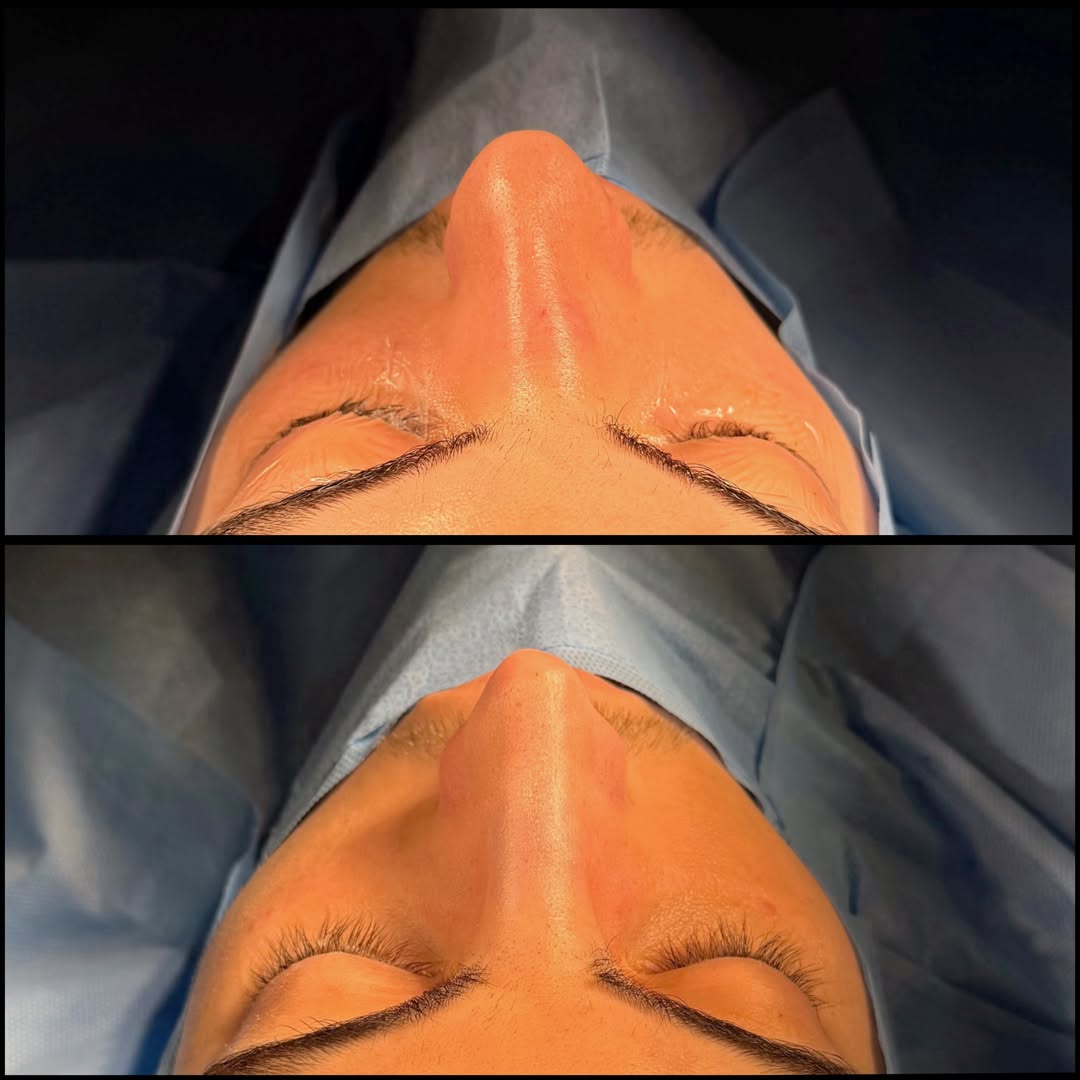 Caso autorizado de base nasal, comparação antes e depois em vista inferior