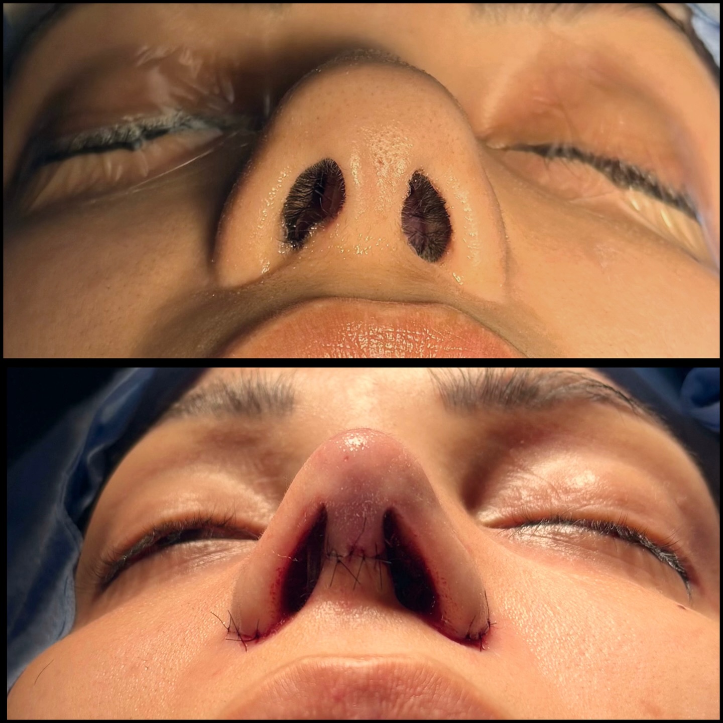 Caso autorizado de base nasal, comparação antes e depois em vista inferior