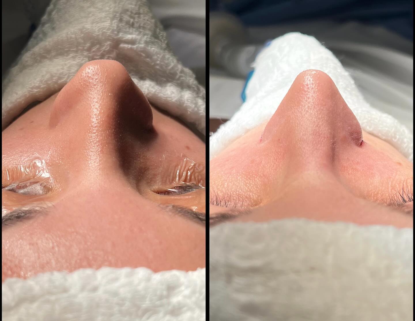 Caso autorizado de base nasal, comparação antes e depois em vista inferior