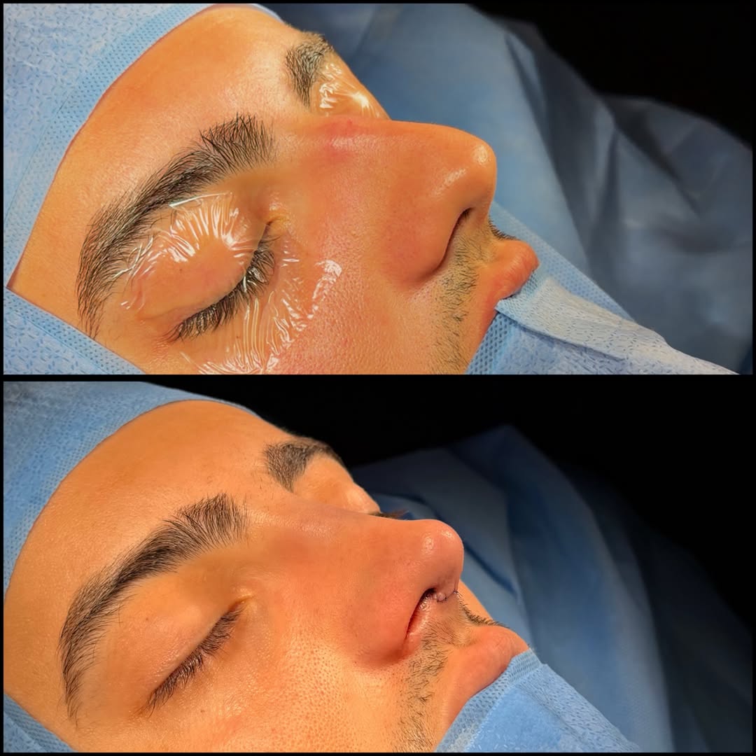 Caso masculino autorizado de base nasal, comparação antes e depois em perfil