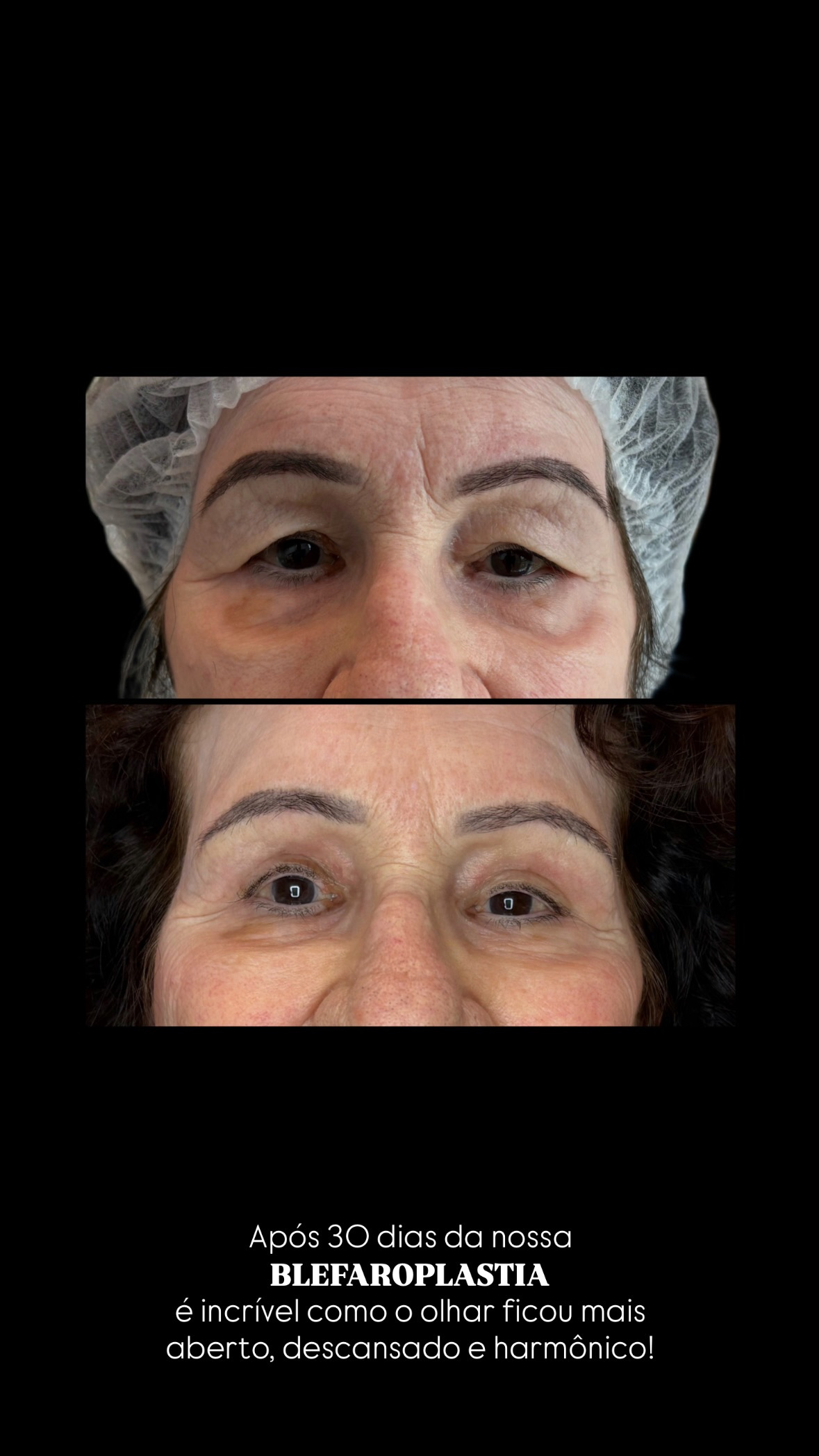 Caso autorizado de blefaroplastia, comparação frontal antes e depois