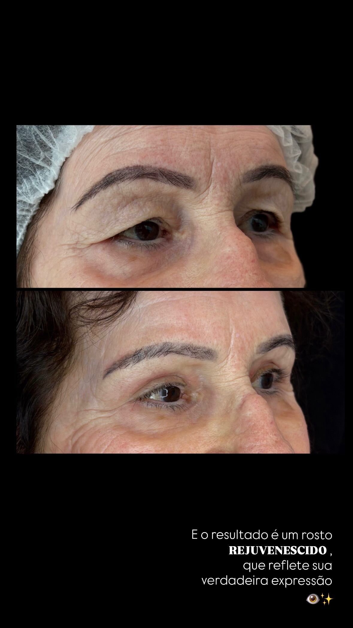 Caso autorizado de blefaroplastia, comparação oblíqua antes e depois