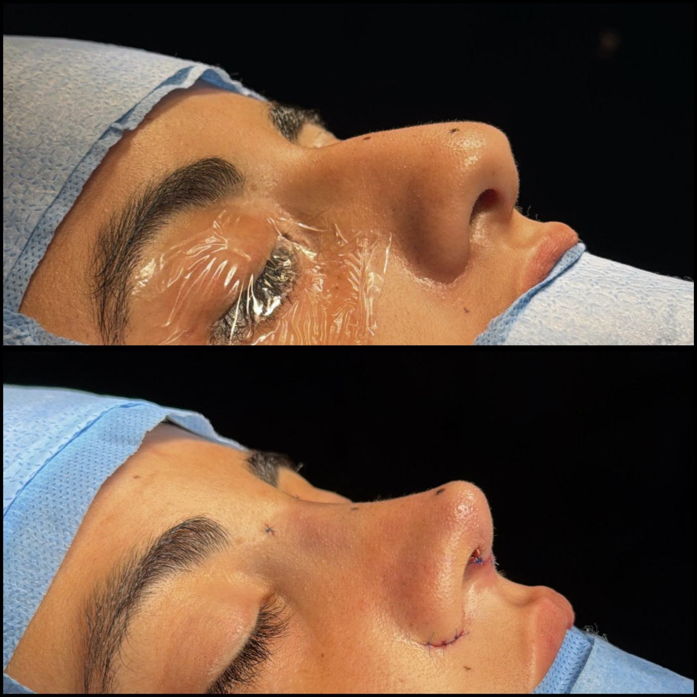 Registro cirúrgico autorizado de rinoplastia em perfil