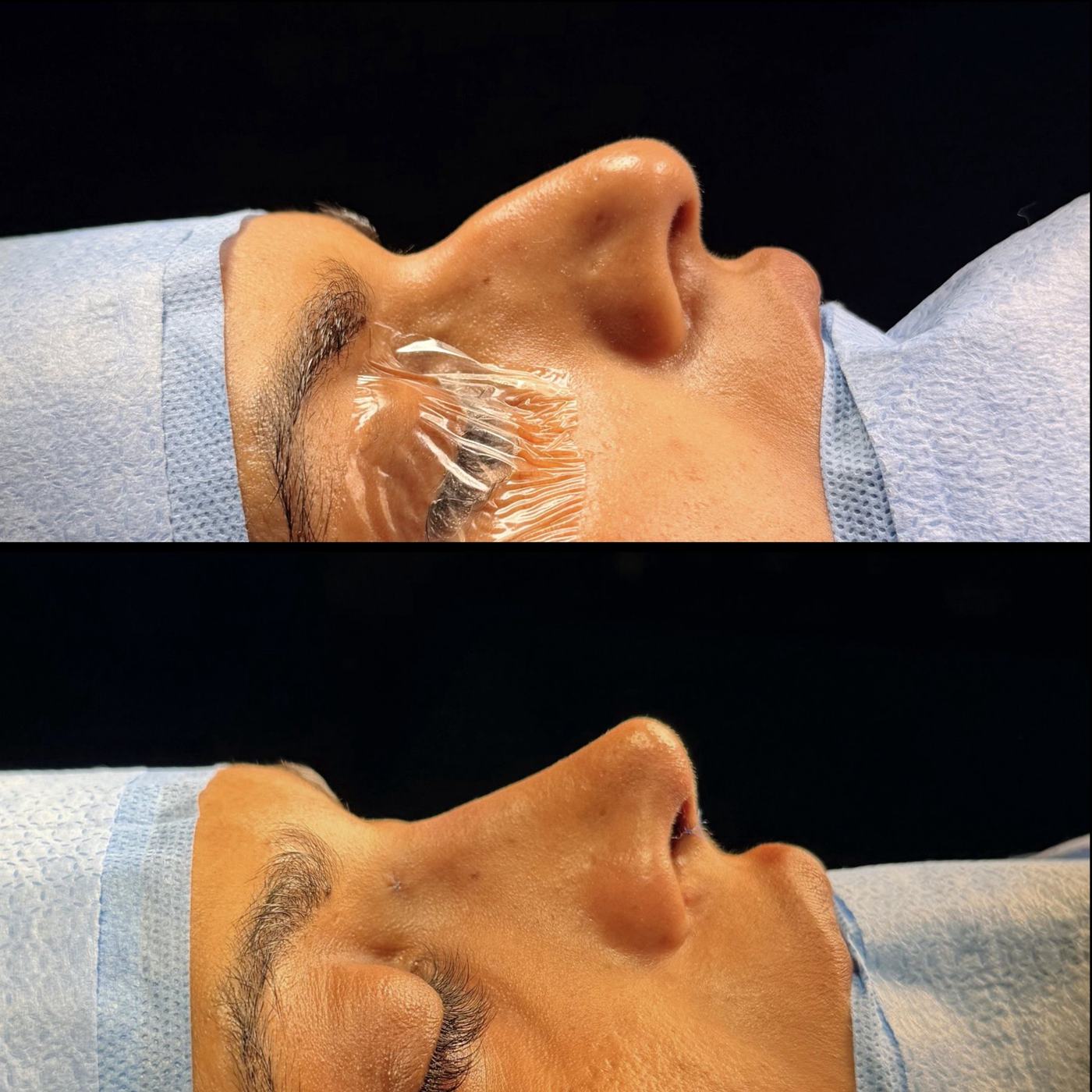 Registro cirúrgico autorizado de rinoplastia