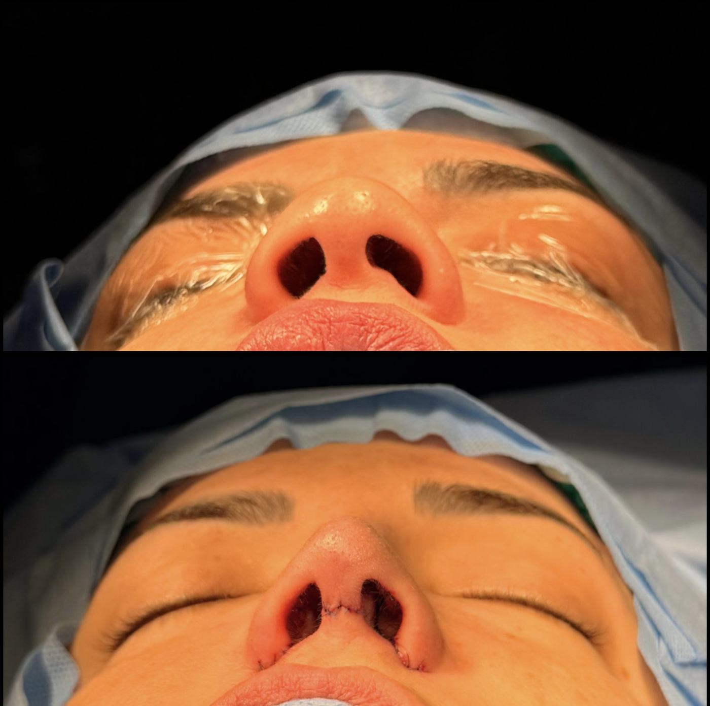 Registro cirúrgico autorizado de rinoplastia em vista inferior
