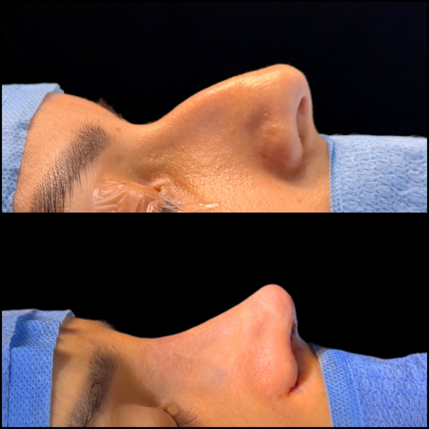 Caso de rinoplastia, comparação antes e depois em vista inferior