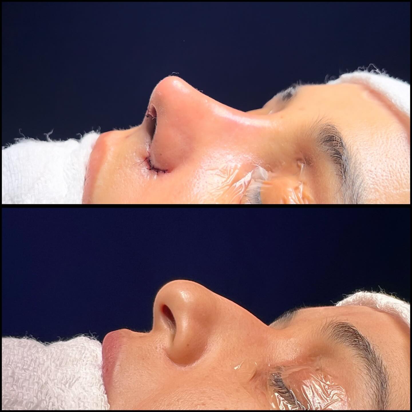 Caso autorizado de rinoplastia, comparação antes e depois em perfil inferior