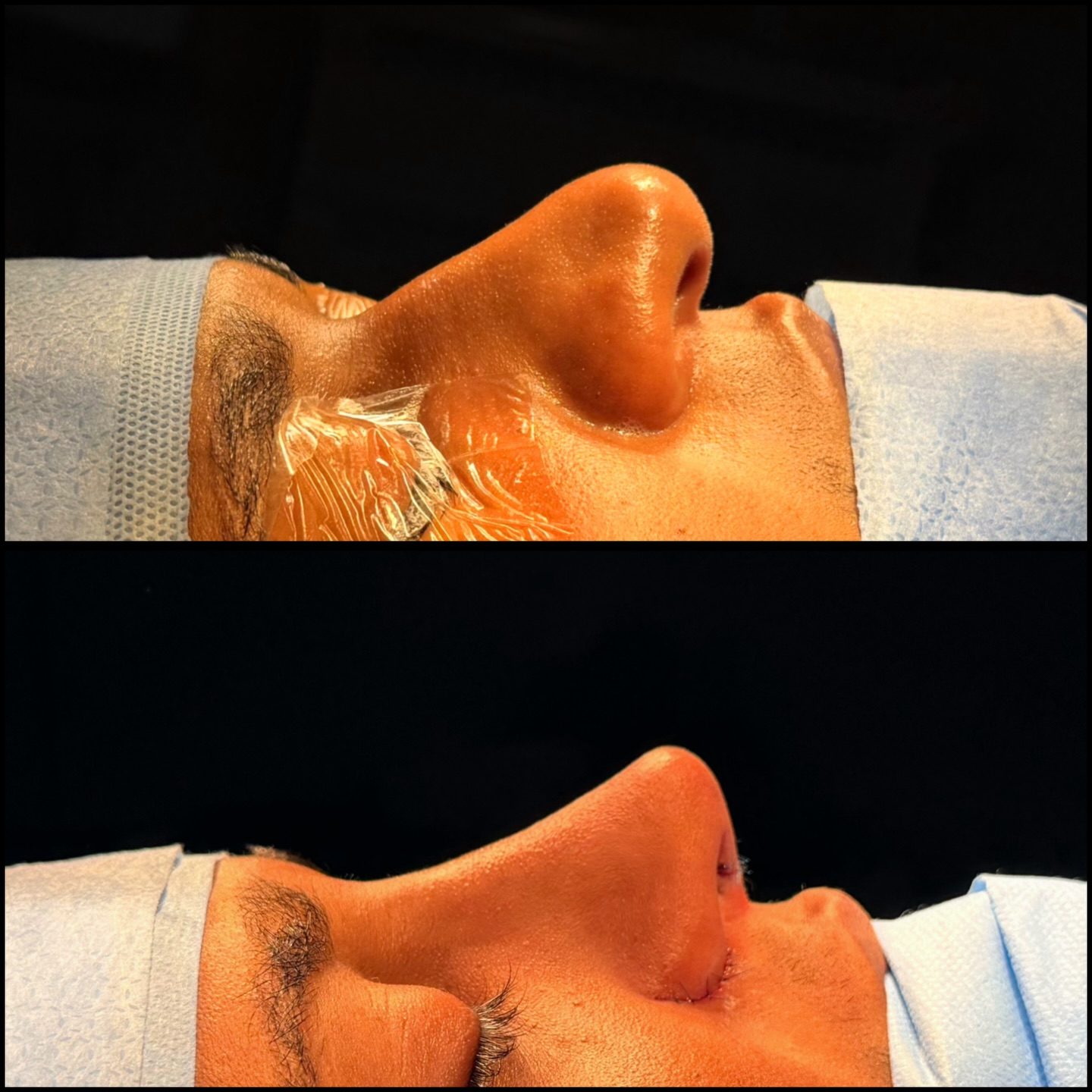 Caso masculino autorizado de rinoplastia, perfil antes e depois