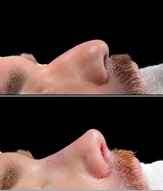 Caso masculino autorizado de rinoplastia em perfil