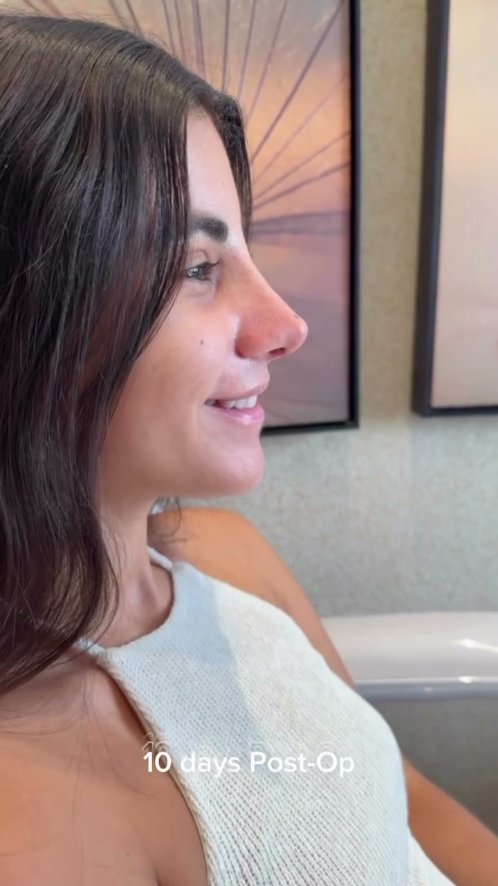 Paciente em acompanhamento pós-operatório de rinoplastia