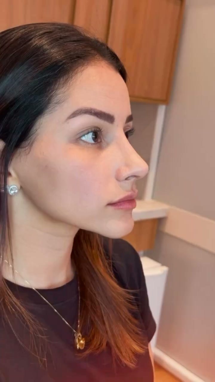 Paciente mostrando o resultado da rinoplastia em perfil