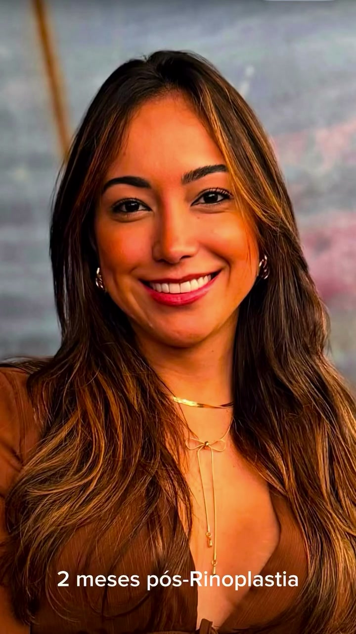 Paciente dois meses após a rinoplastia