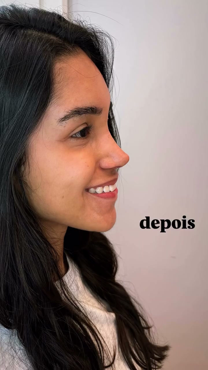 Comparação autorizada de antes e depois da rinoplastia
