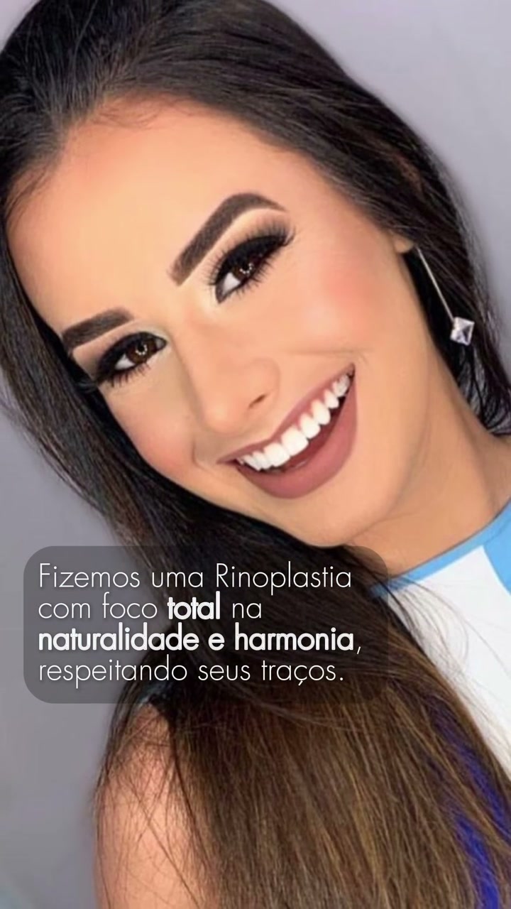 Resultado autorizado de rinoplastia com foco em naturalidade